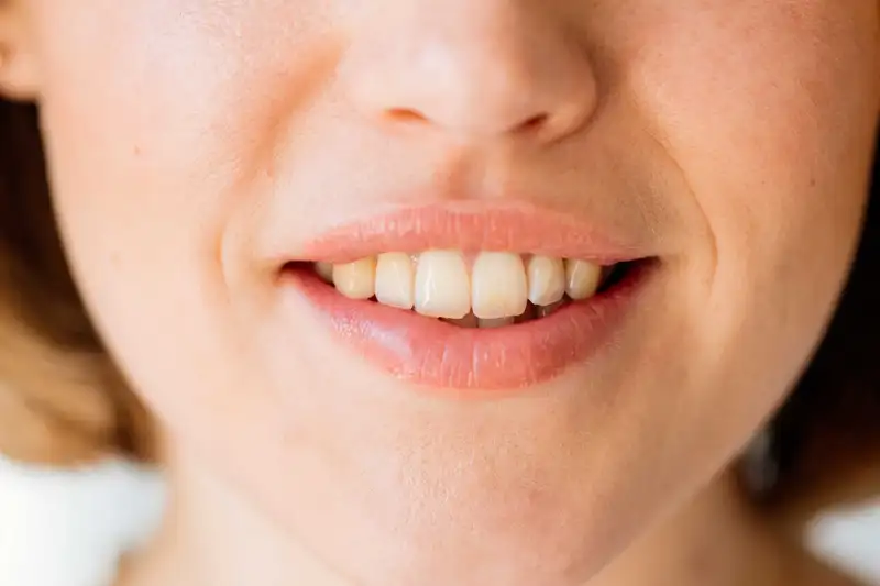 Cavities could be prevented by a gel that restores tooth enamel